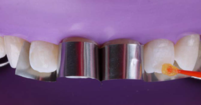 Solventum – Die ästhetische Zahnrestauration mit Dr. Cura