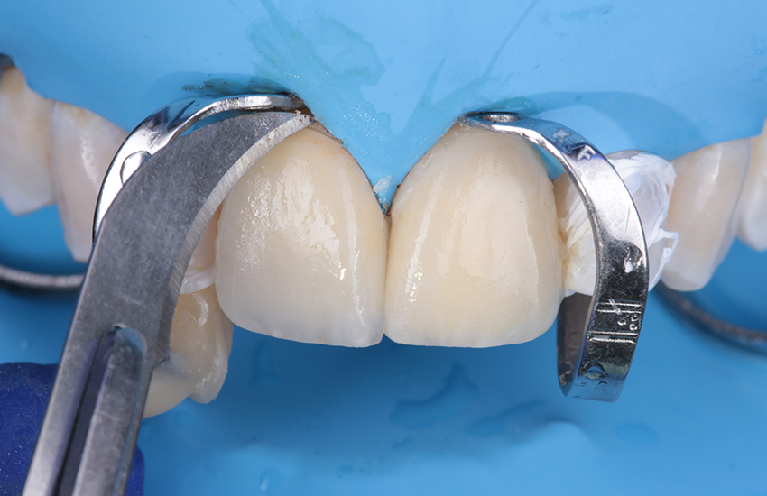 7. Lichthärtung und finale Reinigung