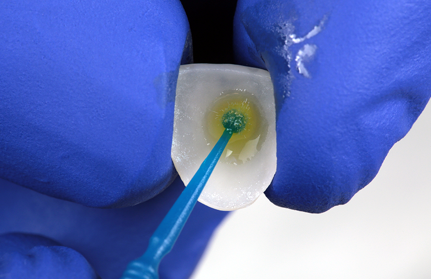 4. Veneer-Vorbehandlung