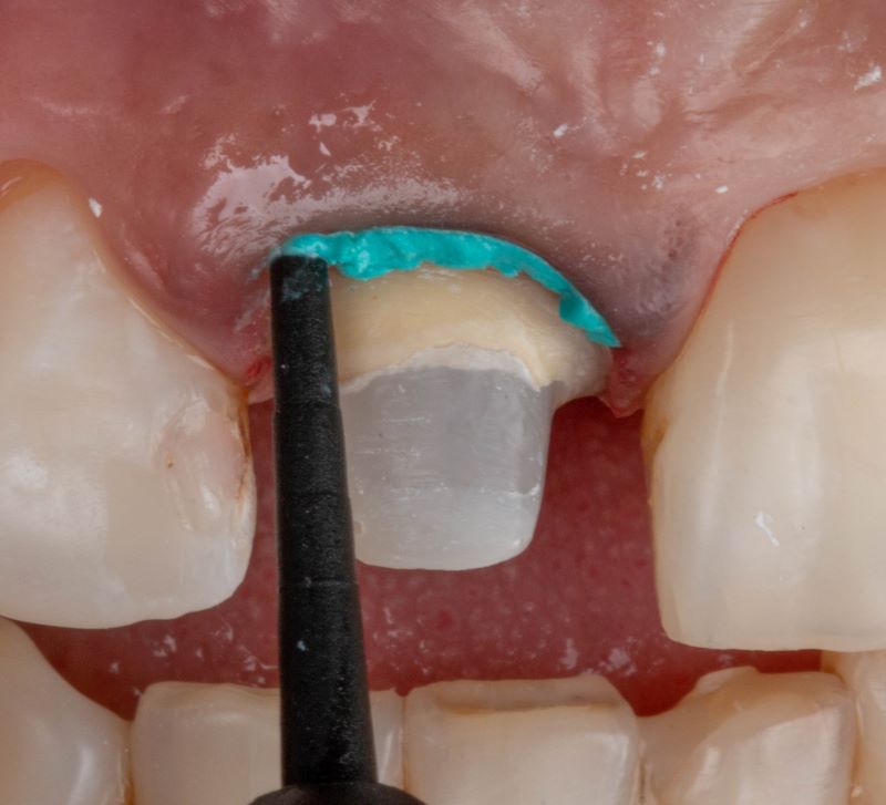 Voco Retraction Paste in der Anwendung