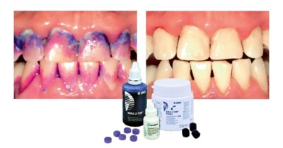 Mira-2-Ton: Dentalen Biofilm sichtbar machen