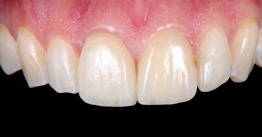 Perfekte Veneer-Befestigung mit Solventum | Plandent