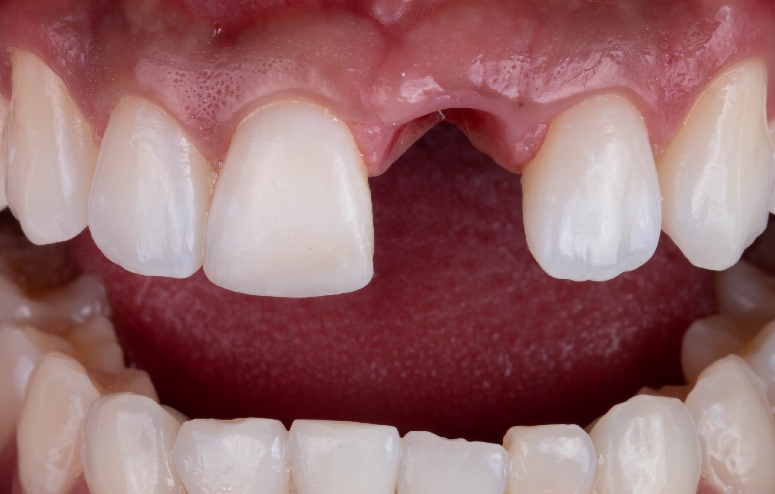 Sehr gute klinische Ausgangssituation 6 Monate nach Setzen und Einheilen des Implantats.