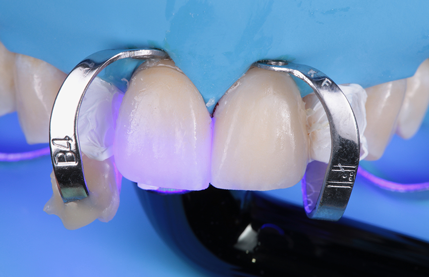 7. Lichthärtung und finale Reinigung