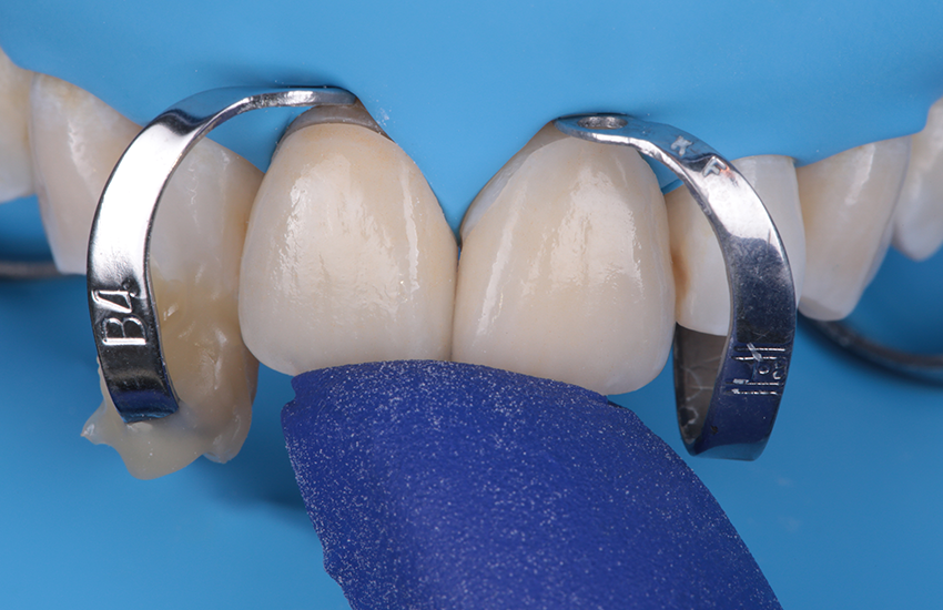 3. Isolation und finale Anprobe