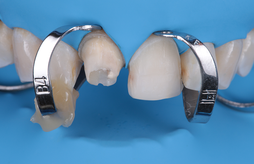 3. Isolation und finale Anprobe