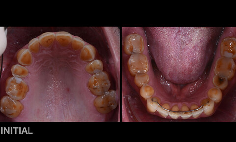 CMD- und Bruxismus-bedingte schwere generalisierte Defekte mit Verlust der Bisshöhe. Verfärbung der Zähne; kariöse Läsion 35 distal und leichte, lokal begrenzte vereinzelte parodontale Veränderungen.