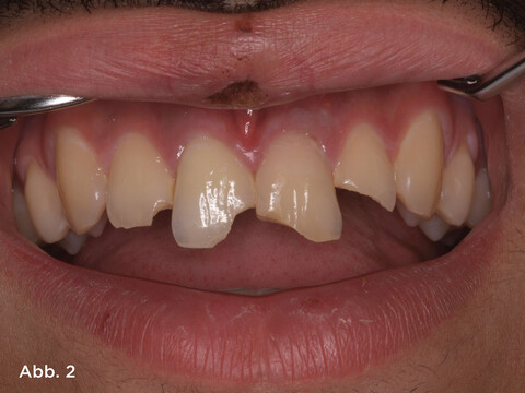 Intraoral wiesen die vier oberen Schneidezähne Dentin-Schmelz-Frakturen ohne Pulpaeröffnung auf (Abb. 2). 