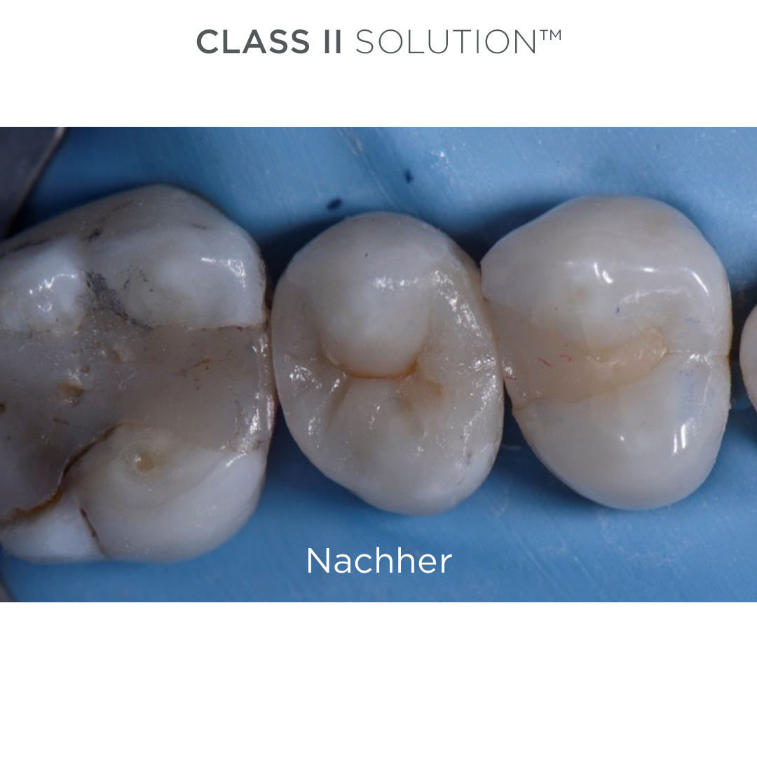 Nachher Palodent SDR