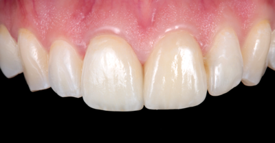 Perfekte Veneer-Befestigung mit Solventum | Plandent