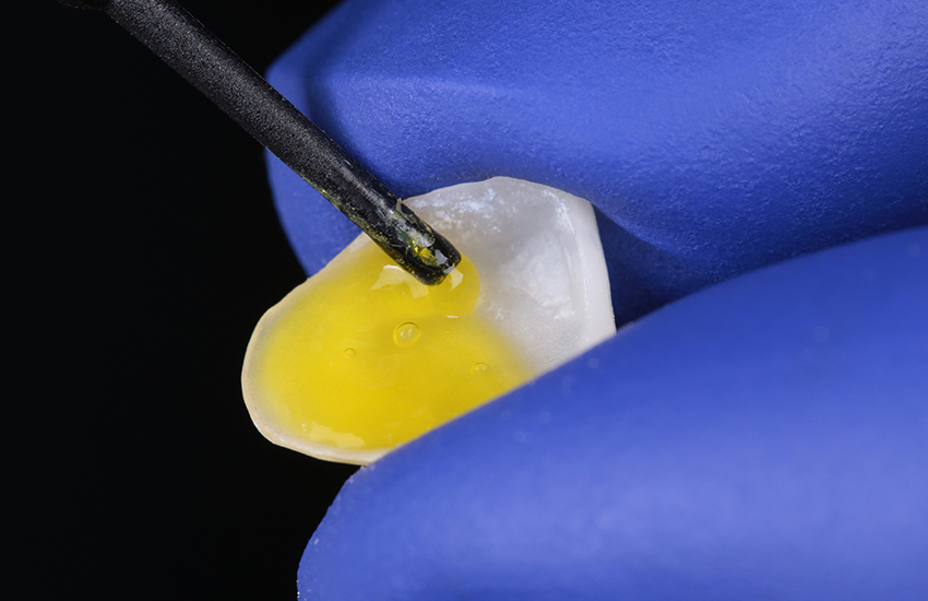 4. Veneer-Vorbehandlung