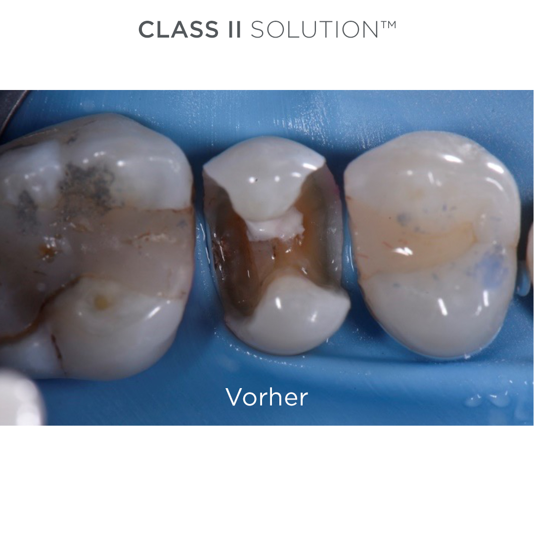 Vorher Palodent SDR